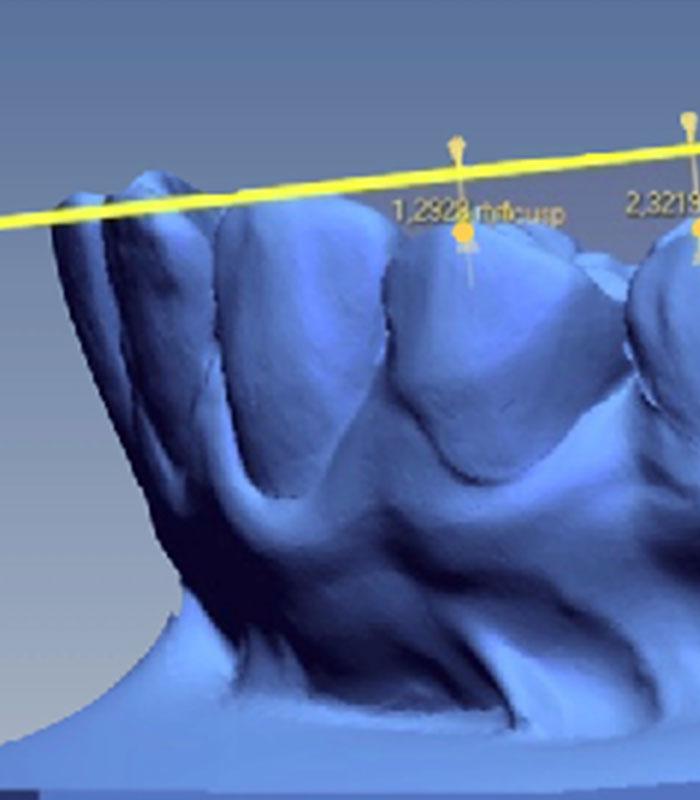 Escaneado dental 3d intraoral en clínica Suma + Dental en Zaragoza