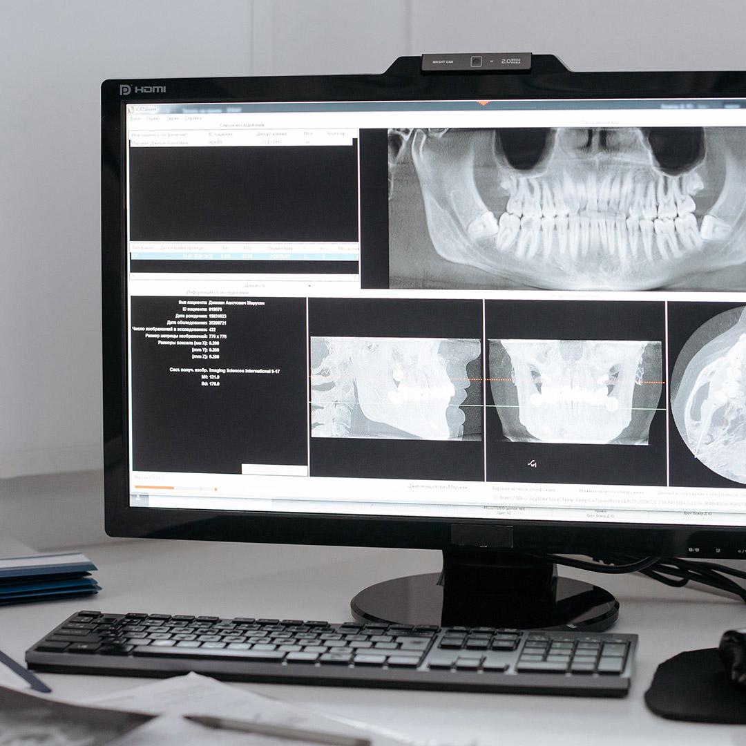 Imagen de la sección Regeneración ósea en Clínica Suma + Dental en Zaragoza