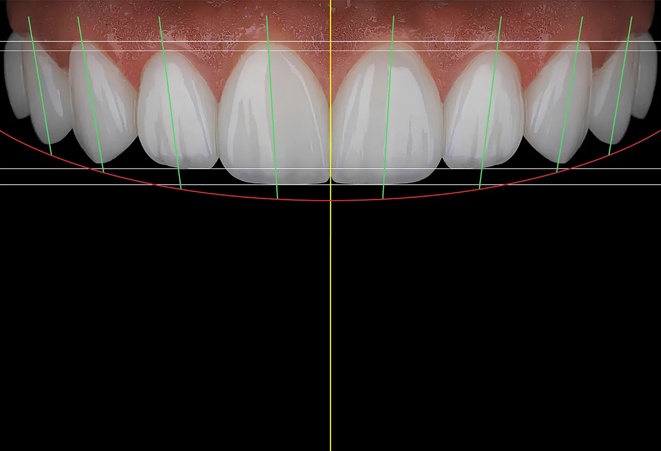 Diseño digital de sonrisa