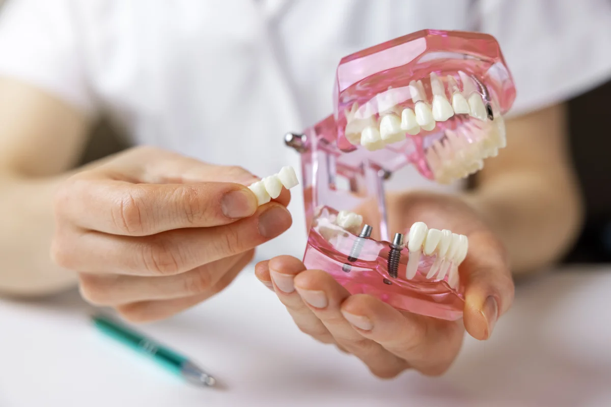 Implantes múltiples