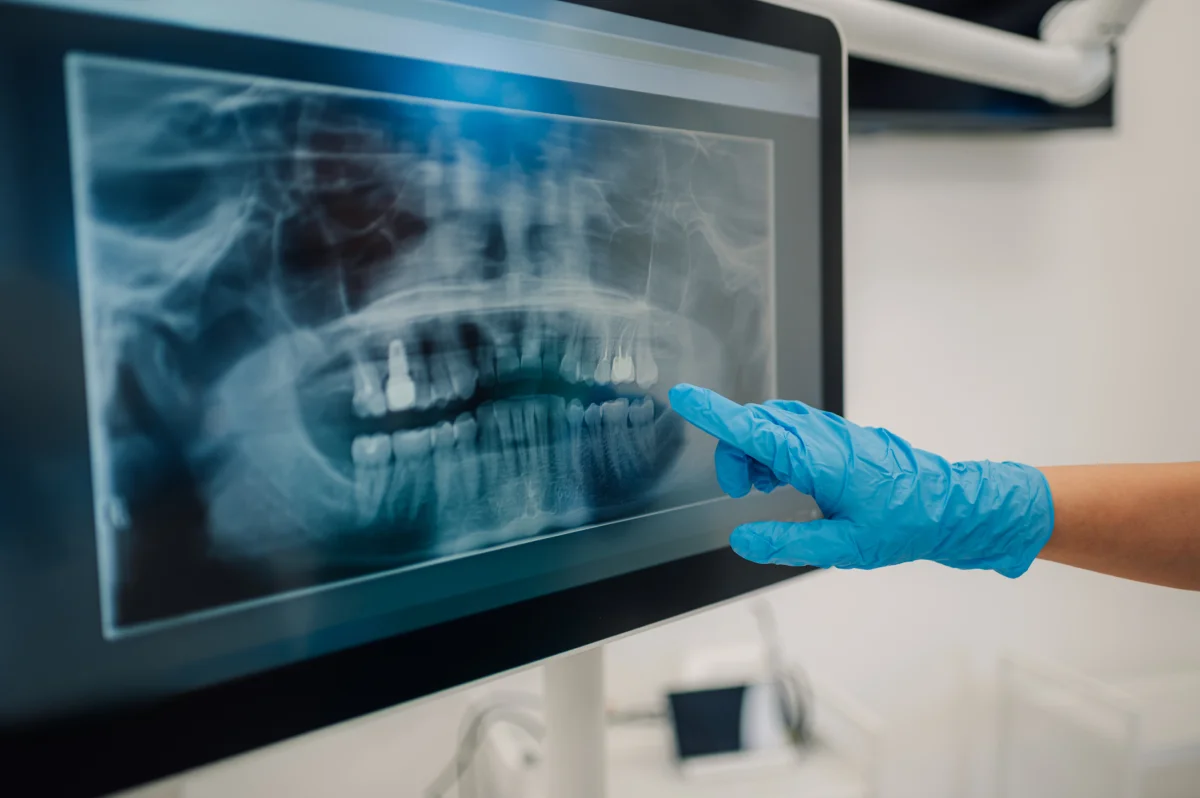 Solución con implantes dentales