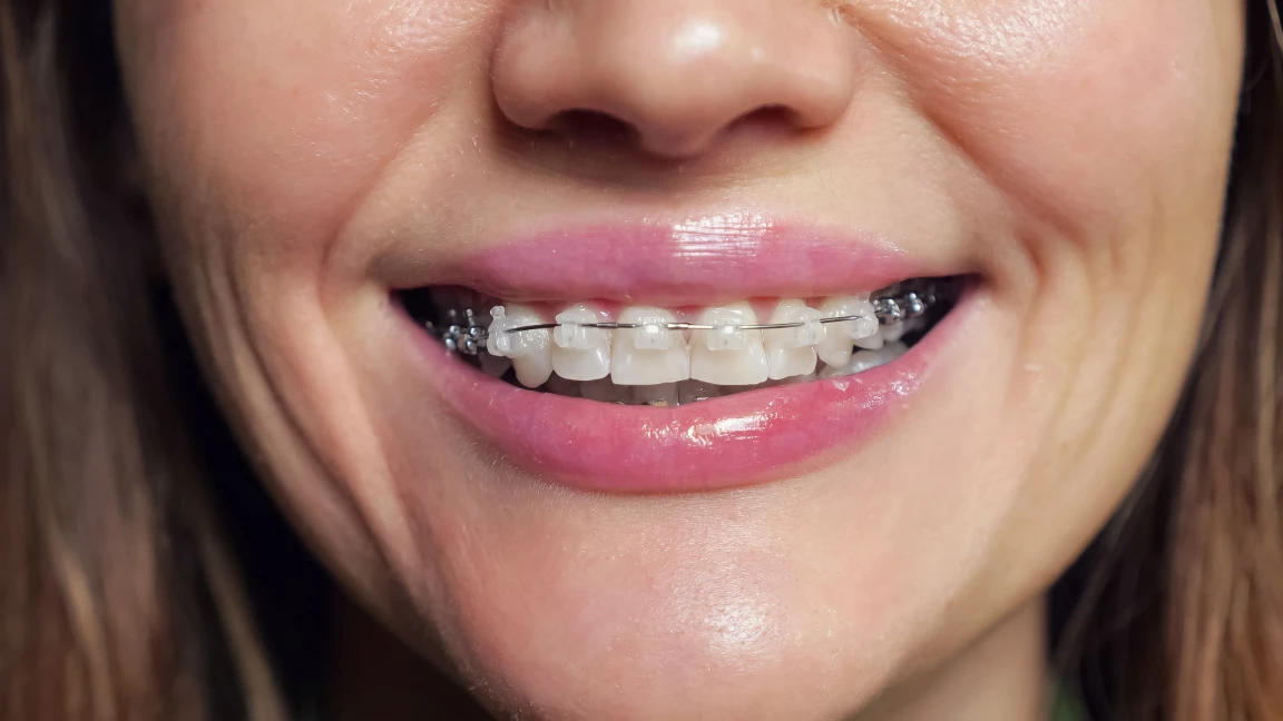 Brackets estéticos