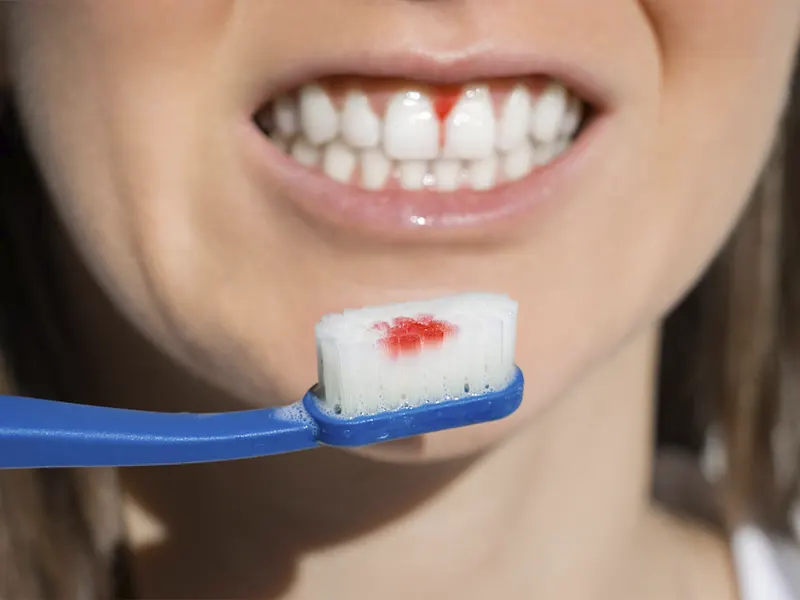 Mujer con sangrado de encías al cepillarse los dientes