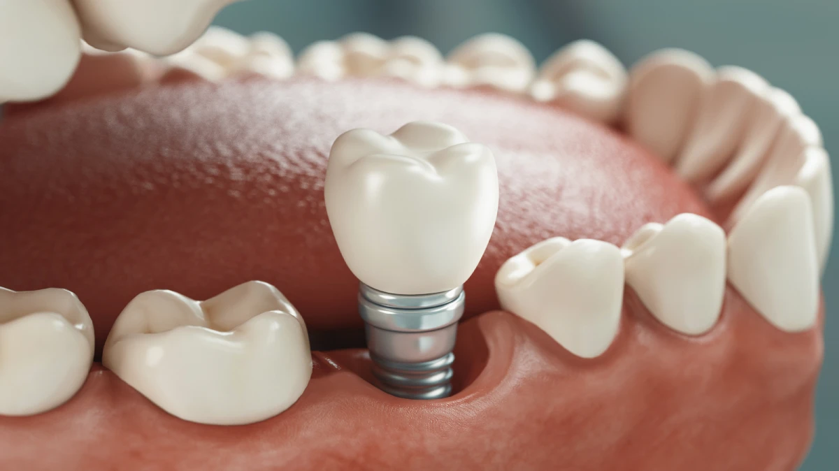 Tratamientos con implantes dentales